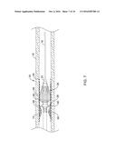 ATHERECTOMY MEDICAL DEVICE diagram and image