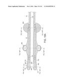 Rotational Atherectomy Device with Distal Protection Capability and Method     of Use diagram and image