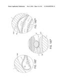 Rotational Atherectomy Device with Distal Protection Capability and Method     of Use diagram and image