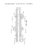 Rotational Atherectomy Device with Distal Protection Capability and Method     of Use diagram and image