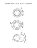 Rotational Atherectomy Device with Distal Protection Capability and Method     of Use diagram and image