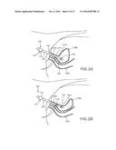 URETHRAL-INSERTION DEVICE diagram and image