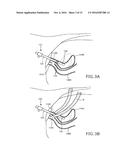 URETHRAL-INSERTION DEVICE diagram and image