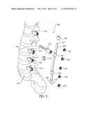 Disc and Motion Preserving Implant System diagram and image