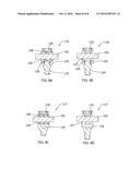 Disc and Motion Preserving Implant System diagram and image