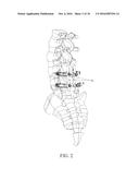 PEDICLE SCREW AND MULTI-AXIAL CONNECTOR SYSTEM diagram and image