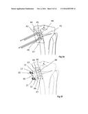 OSTEOTOMY IMPLANT diagram and image