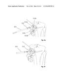 OSTEOTOMY IMPLANT diagram and image