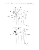OSTEOTOMY IMPLANT diagram and image
