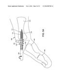 RETROGRADED HAMMERTOE COMPRESSION SCREW IMPLANT AND METHODS OF IMPLANTING     THE SAME diagram and image