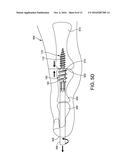 RETROGRADED HAMMERTOE COMPRESSION SCREW IMPLANT AND METHODS OF IMPLANTING     THE SAME diagram and image