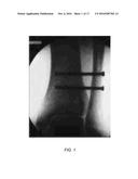 DEVICES, SYSTEMS, AND METHODS FOR SEMI-RIGID BONE FIXATION diagram and image