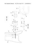 DEVICES, SYSTEMS, AND METHODS FOR SEMI-RIGID BONE FIXATION diagram and image