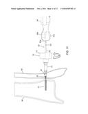 DEVICES, SYSTEMS, AND METHODS FOR SEMI-RIGID BONE FIXATION diagram and image