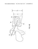 METHOD FOR BALLOON-ASSISTED AUGMENTATION AND FUSION OF ADJACENT VERTEBRAL     BODIES diagram and image