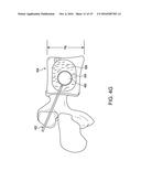 METHOD FOR BALLOON-ASSISTED AUGMENTATION AND FUSION OF ADJACENT VERTEBRAL     BODIES diagram and image