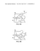 METHOD FOR BALLOON-ASSISTED AUGMENTATION AND FUSION OF ADJACENT VERTEBRAL     BODIES diagram and image