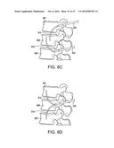 METHOD FOR BALLOON-ASSISTED AUGMENTATION AND FUSION OF ADJACENT VERTEBRAL     BODIES diagram and image