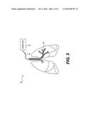 AIRWAY DIAGNOSIS AND TREATMENT DEVICES AND RELATED METHODS OF USE diagram and image