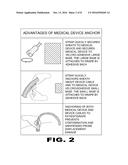 Medical Device Anchor diagram and image