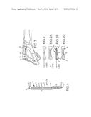 METACARPAL BONE STABILIZATION DEVICE diagram and image