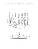 METACARPAL BONE STABILIZATION DEVICE diagram and image