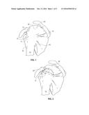 TENDON REPAIR IMPLANT AND METHOD OF ARTHROSCOPIC IMPLANTATION diagram and image