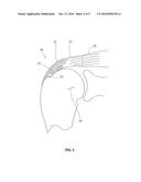 TENDON REPAIR IMPLANT AND METHOD OF ARTHROSCOPIC IMPLANTATION diagram and image