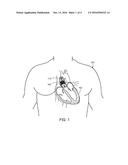 SYNTHETIC HEART VALVES COMPOSED OF ZWITTERIONIC POLYMERS diagram and image