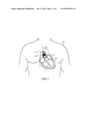 FIBER REINFORCED PROSTHETIC HEART VALVE HAVING UNDULATING FIBERS diagram and image