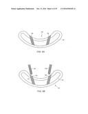 EXPANDABLE ARTICULATING INTERVERTEBRAL IMPLANT WITH LIMITED ARTICULATION diagram and image