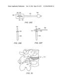 EXPANDABLE ARTICULATING INTERVERTEBRAL IMPLANT WITH LIMITED ARTICULATION diagram and image