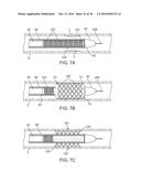 ADJUSTABLE-LENGTH DRUG DELIVERY BALLOON diagram and image