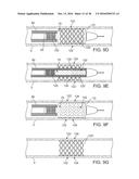 ADJUSTABLE-LENGTH DRUG DELIVERY BALLOON diagram and image