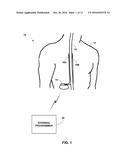 CONTROLLING ELECTRICAL STIMULATION BASED ON EVOKED COMPOUND MUSCLE ACTION     POTENTIAL diagram and image