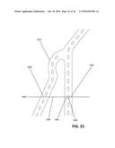 DEVICES AND METHODS FOR TREATING CARDIOVASCULAR AND METABOLIC DISEASE diagram and image