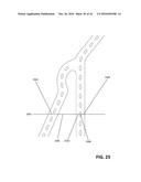 DEVICES AND METHODS FOR TREATING CARDIOVASCULAR AND METABOLIC DISEASE diagram and image