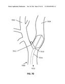 DEVICES AND METHODS FOR TREATING CARDIOVASCULAR AND METABOLIC DISEASE diagram and image