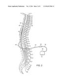 NEUROSTIMULATION LEAD WITH STIFFENED PROXIMAL ARRAY diagram and image