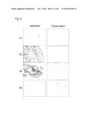 MATERIALS AND METHODS FOR DIAGNOSIS AND PROGNOSIS OF LIVER CANCER diagram and image