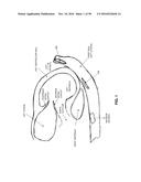 METHOD AND APPARATUS FOR REPAIRING A MITRAL VALVE diagram and image