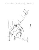 METHOD AND APPARATUS FOR REPAIRING A MITRAL VALVE diagram and image