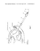 METHOD AND APPARATUS FOR REPAIRING A MITRAL VALVE diagram and image