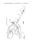 METHOD AND APPARATUS FOR REPAIRING A MITRAL VALVE diagram and image