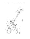 METHOD AND APPARATUS FOR REPAIRING A MITRAL VALVE diagram and image