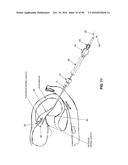 METHOD AND APPARATUS FOR REPAIRING A MITRAL VALVE diagram and image