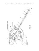 METHOD AND APPARATUS FOR REPAIRING A MITRAL VALVE diagram and image