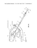 METHOD AND APPARATUS FOR REPAIRING A MITRAL VALVE diagram and image