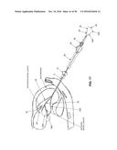 METHOD AND APPARATUS FOR REPAIRING A MITRAL VALVE diagram and image