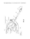 METHOD AND APPARATUS FOR REPAIRING A MITRAL VALVE diagram and image